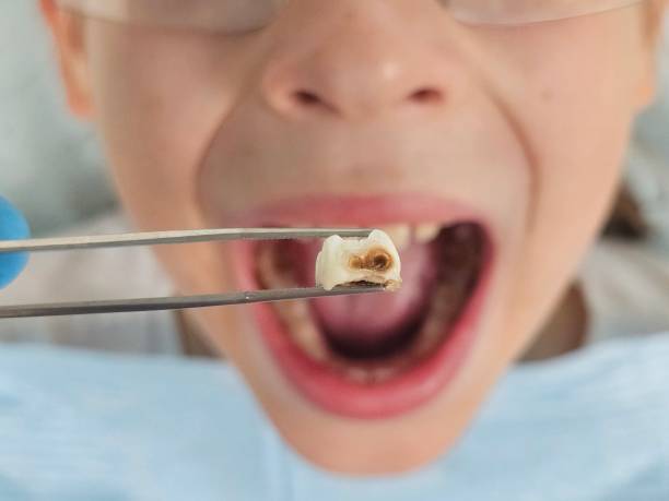 Best Emergency Dental Extractions in Burlington, ND