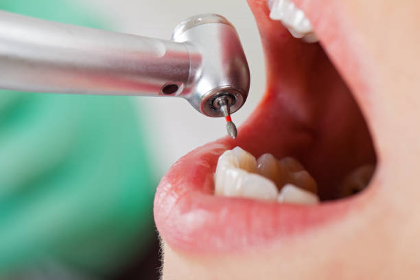 Best Emergency Dentist for Knocked-Out Tooth in Burlington, ND
